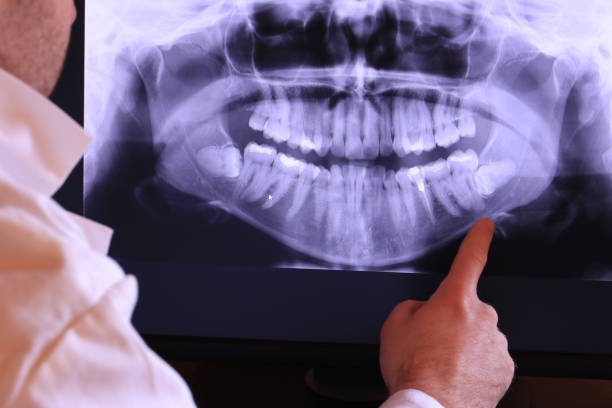 Best Emergency Wisdom Tooth Extraction in Shavano Park, TX
